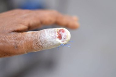 Sol elinin baş parmağı, başparmağının cerrahi müdahaleyle çıkarılması ve parmağa alınan ve çivinin bir kısmının zarar görmesine ve seçici bir şekilde odaklanmasına neden olan doğrudan travmadan sonra kesilen bir yaranın dikişleri.