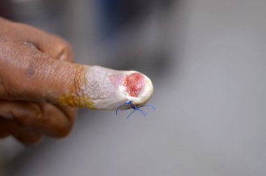 Sol elinin baş parmağı, başparmağının cerrahi müdahaleyle çıkarılması ve parmağa alınan ve çivinin bir kısmının zarar görmesine ve seçici bir şekilde odaklanmasına neden olan doğrudan travmadan sonra kesilen bir yaranın dikişleri.