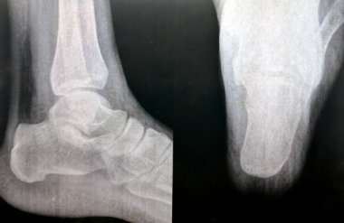 heel calcaneal spur, a calcium deposit causing a bony protrusion on the underside of the heel bone also Plantar Fasciitis , inflammation of the plantar fascia tissue of the foot used in walking clipart