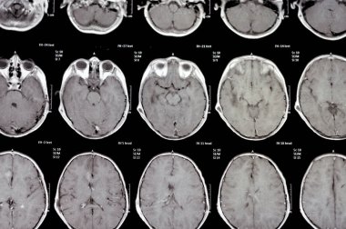 Beyin MR 'ı hidrosefalus vakası için daha önce yapılan şant ameliyatlarını gösteriyor. Sağ ön ventriküler para-falcine lezyonu arttırıyor ve kanama şüphesi neoplastik bileşen olabilir.