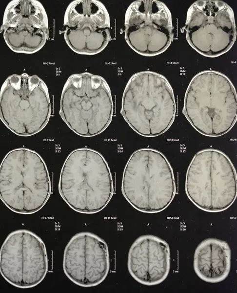 stock image MRI of the brain reveals previous shunt operations for a hydrocephalus case, right frontal pre-ventricular para-falcine enhancing lesion with suspected hemorrhagic component could be neoplastic