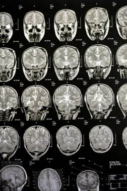 MRI of the brain reveals previous shunt operations for a hydrocephalus case, right frontal pre-ventricular para-falcine enhancing lesion with suspected hemorrhagic component could be neoplastic clipart