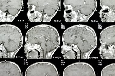 Beyin MR 'ı hidrosefalus vakası için daha önce yapılan şant ameliyatlarını gösteriyor. Sağ ön ventriküler para-falcine lezyonu arttırıyor ve kanama şüphesi neoplastik bileşen olabilir.