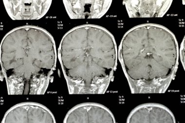 MRI of the brain reveals previous shunt operations for a hydrocephalus case, right frontal pre-ventricular para-falcine enhancing lesion with suspected hemorrhagic component could be neoplastic clipart