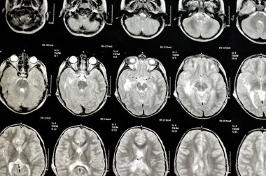 Beyin MR 'ı hidrosefalus vakası için daha önce yapılan şant ameliyatlarını gösteriyor. Sağ ön ventriküler para-falcine lezyonu arttırıyor ve kanama şüphesi neoplastik bileşen olabilir.