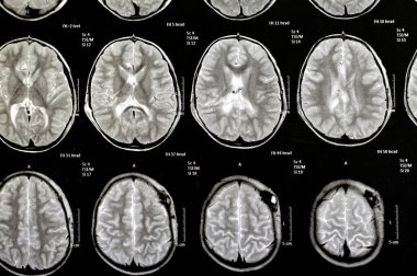 Beyin MR 'ı hidrosefalus vakası için daha önce yapılan şant ameliyatlarını gösteriyor. Sağ ön ventriküler para-falcine lezyonu arttırıyor ve kanama şüphesi neoplastik bileşen olabilir.