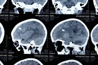 Kahire, Mısır, 17 Eylül 2024: Beyin tomografisi sol şant tüpünün sağ ventriküle gittiğini gösteriyor, ventriküler genişleme, sağ temporal lezyon, bir hidrosefalus vakası yok.