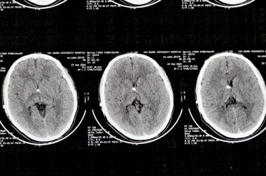 Cairo, Egypt, September 26 2024: A case of Hydrocephalus with a shunt tube, CT scan reveals mild to moderate dilatation of the whole ventricular system, prominent head of caudate, no midline shift clipart