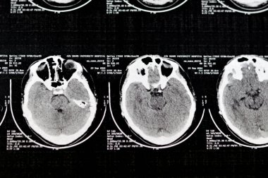 Kahire, Mısır, 26 Eylül 2024: Şant tüplü bir Hydrocephalus vakası, CT taraması gösteriyor ki ventriküler sistemde hafif ve orta hat kayması yok.