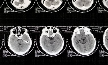 Kahire, Mısır, 26 Eylül 2024: Şant tüplü bir Hydrocephalus vakası, CT taraması gösteriyor ki ventriküler sistemde hafif ve orta hat kayması yok.