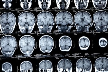 Cairo, Egypt, September 26 2024: MRI brain reveals functioning intra-ventricular shunt drain, small focal area of gliotic changes in right deep peritrigonal white matte, case of Hydrocephalus clipart