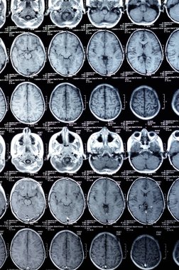 Kahire, Mısır, 26 Eylül 2024: MRI beyin fonksiyonları intra-ventriküler şant drenajı, sağ derin peritrigonal beyaz matte küçük gliyotik odak alanı, hidrosefalus durumu