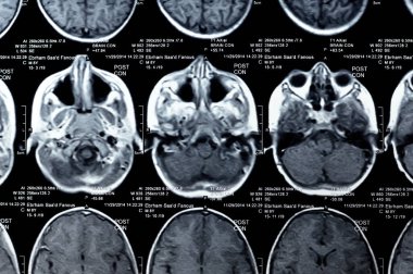 Kahire, Mısır, 26 Eylül 2024: MRI beyin fonksiyonları intra-ventriküler şant drenajı, sağ derin peritrigonal beyaz matte küçük gliyotik odak alanı, hidrosefalus durumu