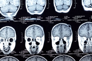 Kahire, Mısır, 26 Eylül 2024: MRI beyin fonksiyonları intra-ventriküler şant drenajı, sağ derin peritrigonal beyaz matte küçük gliyotik odak alanı, hidrosefalus durumu