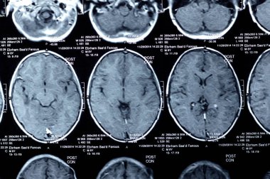 Kahire, Mısır, 26 Eylül 2024: MRI beyin fonksiyonları intra-ventriküler şant drenajı, sağ derin peritrigonal beyaz matte küçük gliyotik odak alanı, hidrosefalus durumu