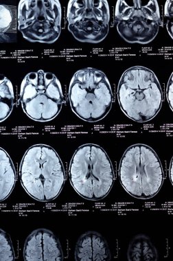 Kahire, Mısır, 26 Eylül 2024: MRI beyin fonksiyonları intra-ventriküler şant drenajı, sağ derin peritrigonal beyaz matte küçük gliyotik odak alanı, hidrosefalus durumu