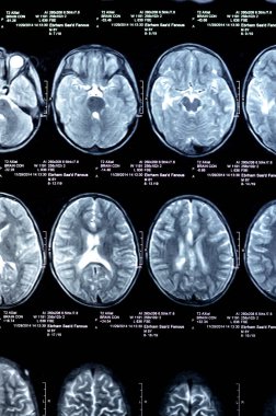 Kahire, Mısır, 26 Eylül 2024: MRI beyin fonksiyonları intra-ventriküler şant drenajı, sağ derin peritrigonal beyaz matte küçük gliyotik odak alanı, hidrosefalus durumu