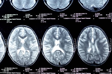 Kahire, Mısır, 26 Eylül 2024: MRI beyin fonksiyonları intra-ventriküler şant drenajı, sağ derin peritrigonal beyaz matte küçük gliyotik odak alanı, hidrosefalus durumu