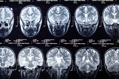 Kahire, Mısır, 26 Eylül 2024: MRI beyin fonksiyonları intra-ventriküler şant drenajı, sağ derin peritrigonal beyaz matte küçük gliyotik odak alanı, hidrosefalus durumu