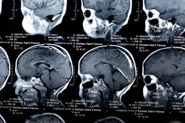 Kahire, Mısır, 26 Eylül 2024: MRI beyin fonksiyonları intra-ventriküler şant drenajı, sağ derin peritrigonal beyaz matte küçük gliyotik odak alanı, hidrosefalus durumu