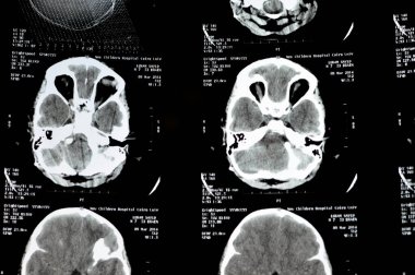 Kahire, Mısır, 26 Eylül 2024: sağ yan şant tüp yerleştirme, genişletilmiş supratentoryal ventriküler sistem, dördüncü karıncıkta yumuşak doku kitle lezyonu şüphesi, hidrosefalus vakası için CT
