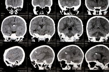 Kahire, Mısır, 17 Eylül 2024: Beyin tomografisi sol şant tüpünün sağ ventriküle gittiğini gösteriyor, ventriküler genişleme, sağ temporal lezyon, bir hidrosefalus vakası yok.