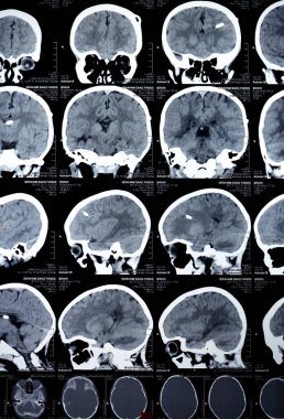 Kahire, Mısır, 17 Eylül 2024: Beyin tomografisi sol şant tüpünün sağ ventriküle gittiğini gösteriyor, ventriküler genişleme, sağ temporal lezyon, bir hidrosefalus vakası yok.