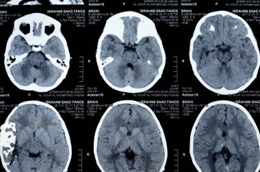 Cairo, Egypt, September 17 2024: Brain CT scan reveals left shunt tube terminating in right lateral ventricle, with no residual ventricular dilatation, right temporal lesion, a case of hydrocephalus clipart