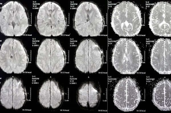 stock image MRI of the brain reveals previous shunt operations for a hydrocephalus case, right frontal pre-ventricular para-falcine enhancing lesion with suspected hemorrhagic component could be neoplastic