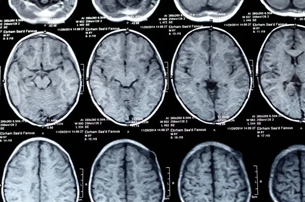 Kahire, Mısır, 26 Eylül 2024: MRI beyin fonksiyonları intra-ventriküler şant drenajı, sağ derin peritrigonal beyaz matte küçük gliyotik odak alanı, hidrosefalus durumu