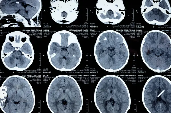Kahire, Mısır, 17 Eylül 2024: Beyin tomografisi sol şant tüpünün sağ ventriküle gittiğini gösteriyor, ventriküler genişleme, sağ temporal lezyon, bir hidrosefalus vakası yok.