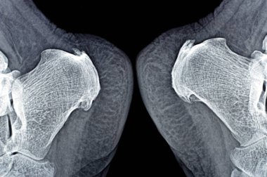 Kadın hasta ayağının röntgeninde kalkaneal topuk çıkıntısı, topuk kemiğinde kemik çıkıntısı, plantar fasiit, lifli dokuda iltihap ve kireçlenmiş aşil tendonu görülüyor.