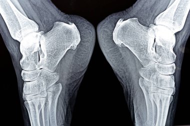 Kadın hasta ayağının röntgeninde kalkaneal topuk çıkıntısı, topuk kemiğinde kemik çıkıntısı, plantar fasiit, lifli dokuda iltihap ve kireçlenmiş aşil tendonu görülüyor.