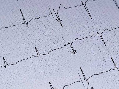 ECG Elektrokardiyografi kağıdı klinik korelasyon için inferolateral T dalgası değişimleri gösteriyor, Dinlenme Kalp ritmi dakikada 65, 41 yaşındaki erkek için anormal EKG, Elektrokardiyogram