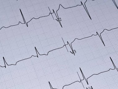 ECG ElectroCardioGraph paper that shows inferolateral T wave changes for clinical correlation, Resting Heart Rate HR 65 beats per minute, Abnormal ECG for a 41 years old male, Electrocardiogram clipart