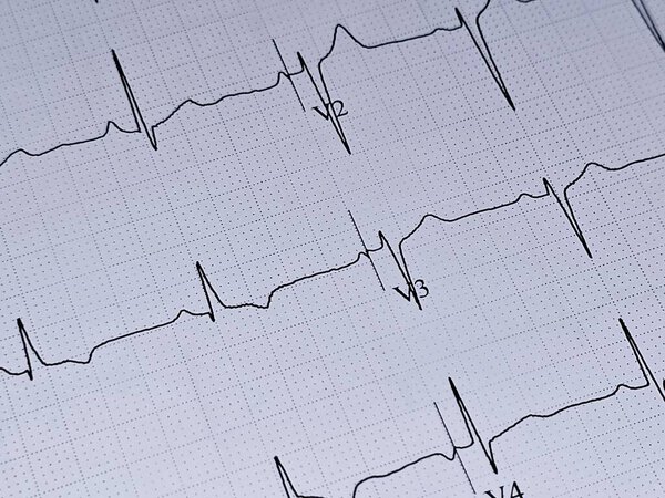 ECG ElectroCardioGraph paper that shows inferolateral T wave changes for clinical correlation, Resting Heart Rate HR 65 beats per minute, Abnormal ECG for a 41 years old male, Electrocardiogram