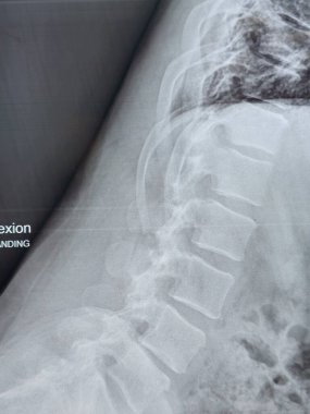 X-ray lumbosacral spine shows straightening of lumbar lordosis due to back muscle spasm, mild rightward lumbar scoliotic deformity, narrowing of L4-L5 disc space, dorsal and lumbar spondylotic changes clipart