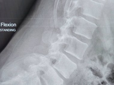 X-ray lumbosacral spine shows straightening of lumbar lordosis due to back muscle spasm, mild rightward lumbar scoliotic deformity, narrowing of L4-L5 disc space, dorsal and lumbar spondylotic changes clipart