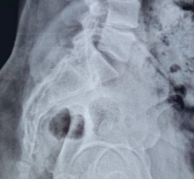 X-ray lumbosacral spine shows straightening of lumbar lordosis due to back muscle spasm, mild rightward lumbar scoliotic deformity, narrowing of L4-L5 disc space, dorsal and lumbar spondylotic changes clipart