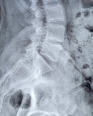 X-ray lumbosakral omurga sırt kası spazmı, hafif sağ bel omurga deformasyonu, L4-L5 disk alanı daralması, sırt ve bel spondilotik değişimlerine bağlı olarak bel lordosisinin düzleştiğini gösteriyor.