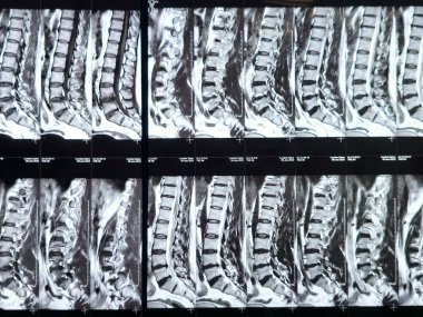 L3-4, L4-5, L5-S1 ve L5-S1 arasındaki omurga alt ve alt bel omurunda Spondylodejeneratif değişimler gösteren manyetik rezonans görüntüleme MRI.