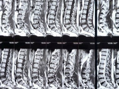 L3-4, L4-5, L5-S1 ve L5-S1 arasındaki omurga alt ve alt bel omurunda Spondylodejeneratif değişimler gösteren manyetik rezonans görüntüleme MRI.