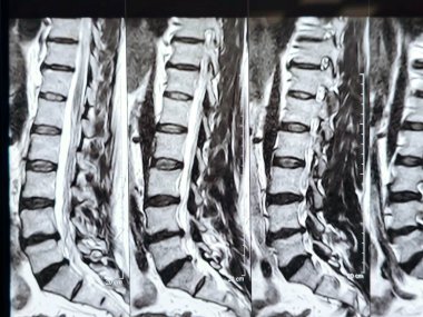 L3-4, L4-5, L5-S1 ve L5-S1 arasındaki omurga alt ve alt bel omurunda Spondylodejeneratif değişimler gösteren manyetik rezonans görüntüleme MRI.