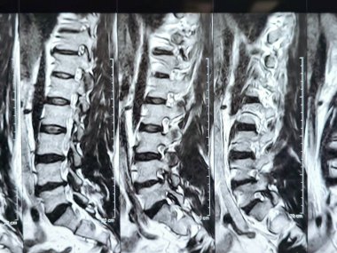 L3-4, L4-5, L5-S1 ve L5-S1 arasındaki omurga alt ve alt bel omurunda Spondylodejeneratif değişimler gösteren manyetik rezonans görüntüleme MRI.
