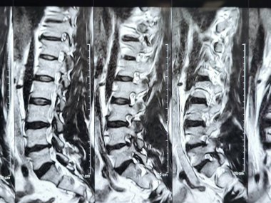 L3-4, L4-5, L5-S1 ve L5-S1 arasındaki omurga alt ve alt bel omurunda Spondylodejeneratif değişimler gösteren manyetik rezonans görüntüleme MRI.