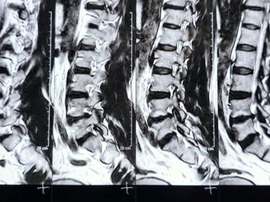 L3-4, L4-5, L5-S1 ve L5-S1 arasındaki omurga alt ve alt bel omurunda Spondylodejeneratif değişimler gösteren manyetik rezonans görüntüleme MRI.