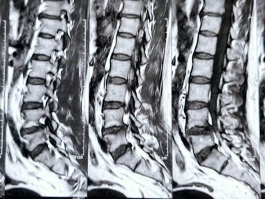 L3-4, L4-5, L5-S1 ve L5-S1 arasındaki omurga alt ve alt bel omurunda Spondylodejeneratif değişimler gösteren manyetik rezonans görüntüleme MRI.
