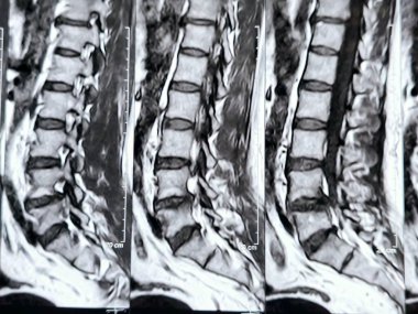 L3-4, L4-5, L5-S1 ve L5-S1 arasındaki omurga alt ve alt bel omurunda Spondylodejeneratif değişimler gösteren manyetik rezonans görüntüleme MRI.
