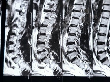 L3-4, L4-5, L5-S1 ve L5-S1 arasındaki omurga alt ve alt bel omurunda Spondylodejeneratif değişimler gösteren manyetik rezonans görüntüleme MRI.