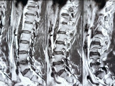 L3-4, L4-5, L5-S1 ve L5-S1 arasındaki omurga alt ve alt bel omurunda Spondylodejeneratif değişimler gösteren manyetik rezonans görüntüleme MRI.